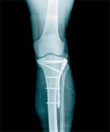 Radiografía de rodilla intervenida quirúrgicamente